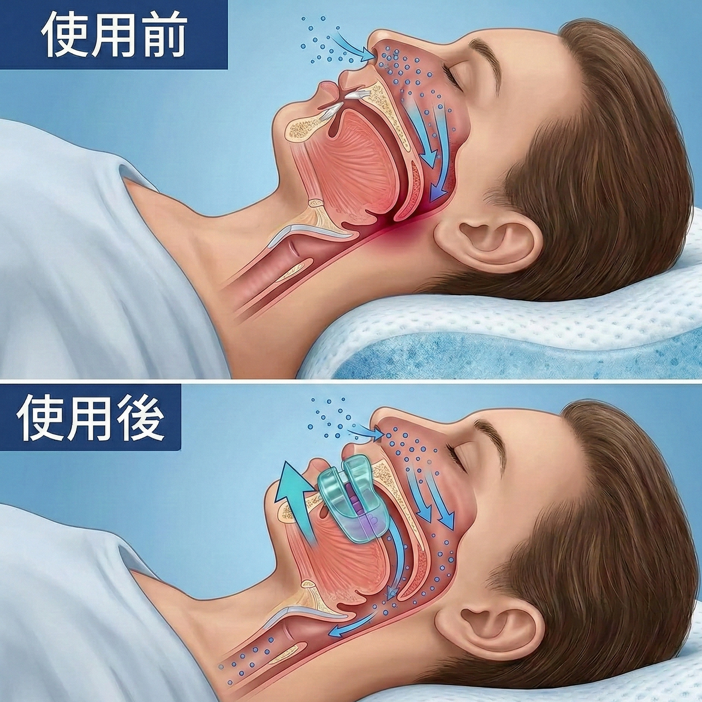 ヴォラ™マウスピース (最大85%OFF)